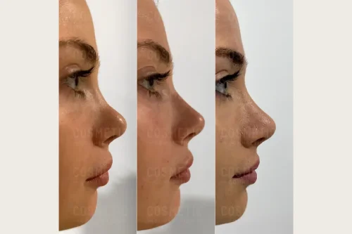 هر آنچه پیش از تزریق فیلر بینی باید بدانید